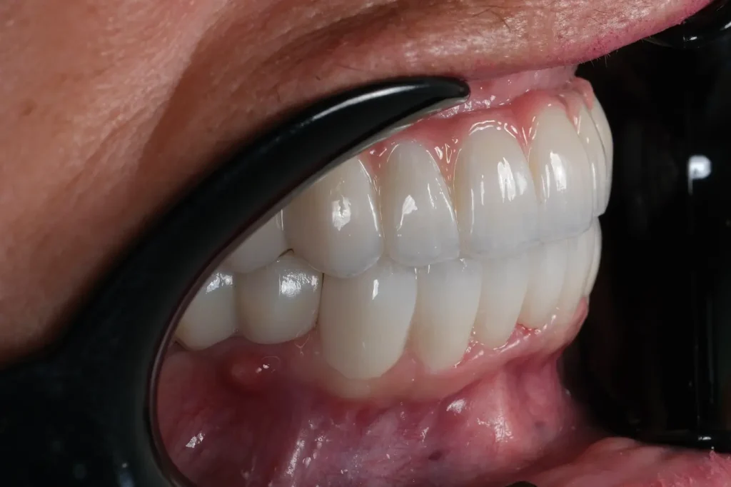 Right view after full-mouth restoration at DentVita