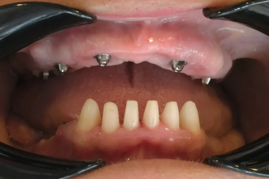 Before full-mouth restoration treatment at DentVita